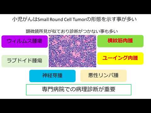 ユーイング肉腫