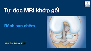 MRI khớp gối: Rách sụn chêm khớp gối