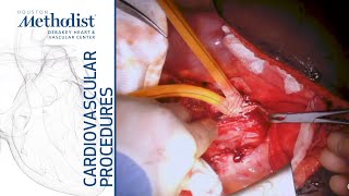 Download Lagu Retrograde Aortic to Superior Mesenteric and Hepatic Artery Bypass (A. Lumsden, MD; M. Zubair, MD) Thumbnail