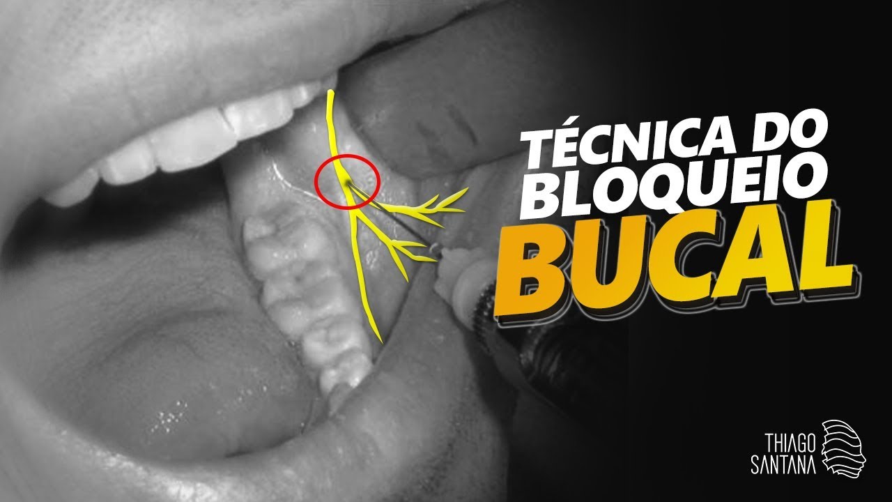 Técnica de Anestesia de Bloqueio do Nervo Bucal