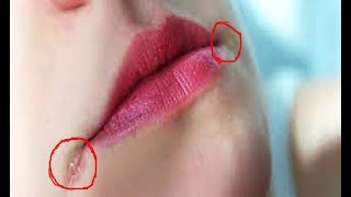 Home Remedies For Angular Cheilitis Cracks in Corners of Mouth