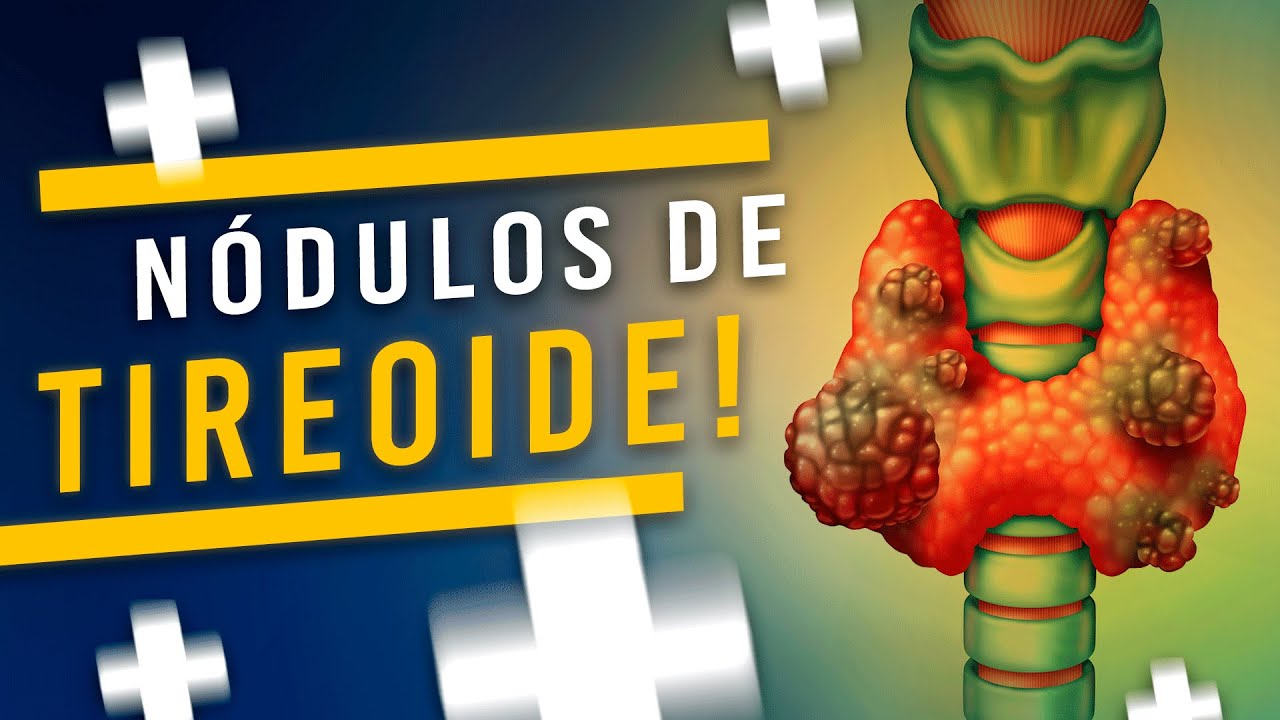 Nódulos na tireoide são perigosos? Quais Os Principais Problemas? [REPLAY]