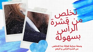 وصفة منزلية فعالة جدا للتخلص من القشرة و الزهم رائعة و مضمونة