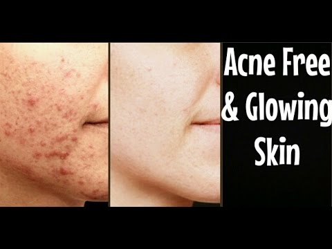 Acne Free & Glowing Skin in 1 Quick Step | Cheap Tip #168 Video
