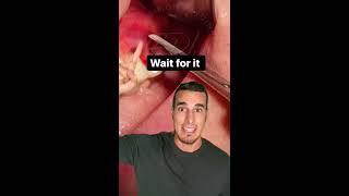 Tremenda INFECCIÓN con FLEMÓN o ABSCESO DENTAL - Todo esto tenía dentro de la ENCÍA