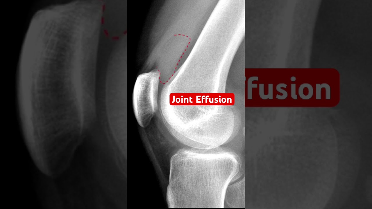 Joint Effusion of the Knee #kneepain #bones #medical