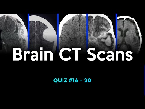 Brain CT Scans: Quiz #16 - 20