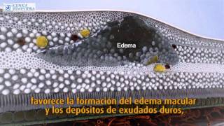 ¿Que es el Edema Macular Diabético?