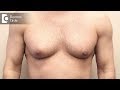 Can Gynaecomastia Or Male Boobs Be Treated By Medicines Only Dr Srikanth V