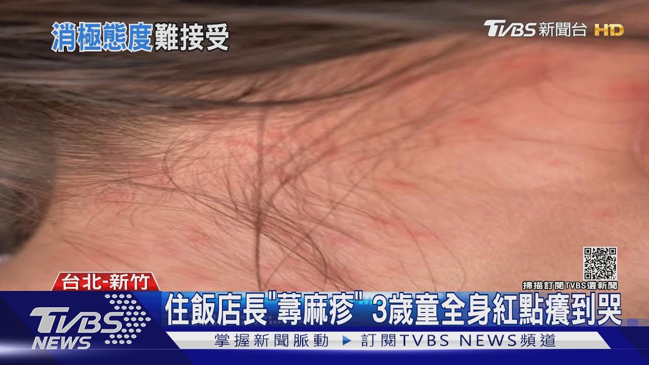 住飯店長「蕁麻疹」　3歲童全身紅點癢到哭