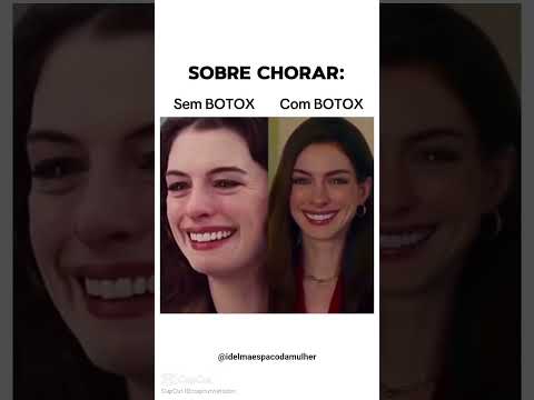 Botox suaviza as rugas, deixa a pele mais jovem e melhora a aparência.#botox #botoxnatural