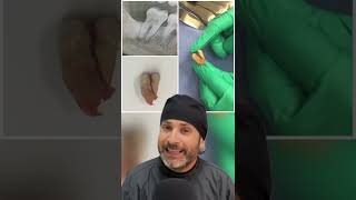 ¿Sabes que es una FRACTURA VERTICAL EN UN DIENTE