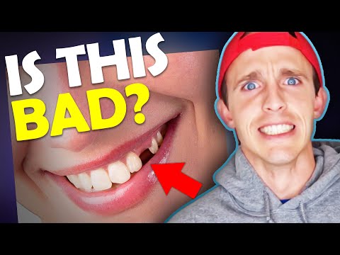 IMPACTED CANINE...Watch this BEFORE you EXTRACT!! | McKinney Orthodontist