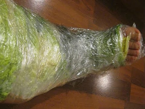 Эндопротезирование коленного сустава упражнения по периодам Передняя крестообразная связка коленного сустава фото