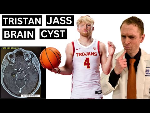 Tristan Jass Brain Cyst Explained by Neurologist