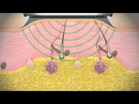 MiraDry® Technology Procedure - Dr. George P. Chatson