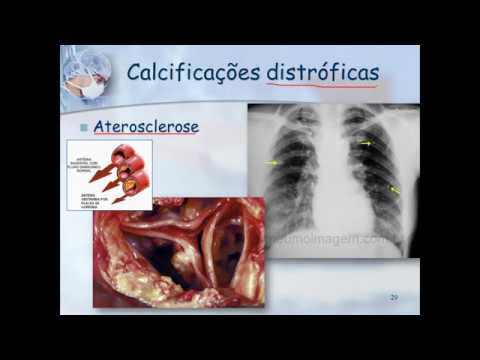 General Pathology | Pathological Calcifications