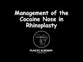 Management Of The Cocaine Nose In Rhinoplasty