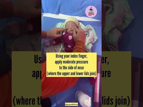 How to treat Baby Watery Eyes| Nasolacrimal duct obstruction