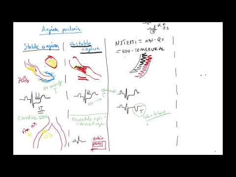 ACS 3a ENG (Acute coronary syndrome, myocardial infarction, STEMI, NSTEMI, transmural, Q infarction)