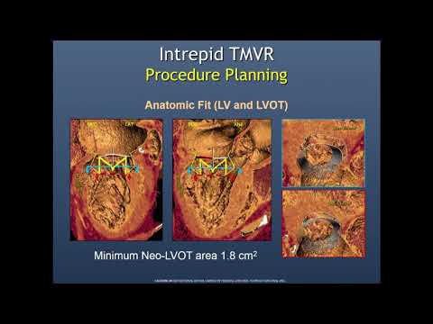 The Medtronic Intrepid: What’s Coming - Michael Reardon, MD