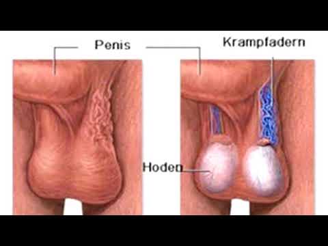 Behandlung von Prostatitis und Blasenentzündung Volksmittel Betrieb Adenokarzinom der Prostata