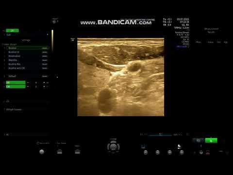 BVV – 63T – AN NINH – NHÂN THÙY TRÁI TUYẾN GIÁP (TI - 3 ) – 02 LAM KÍNH