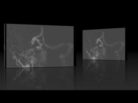 Nuances of transarterial and transvenous embolization of a large tentorial arteriovenous fistula