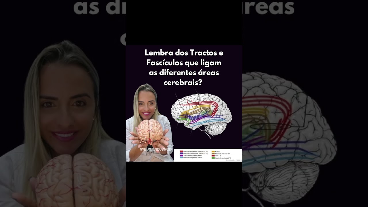 Exame de Tractografia que evidencia as principais vias cerebrais - Fonovim