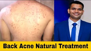 Back Acne (Bacne) - Remove Back Acne Naturally | Dr Vivek Joshi
