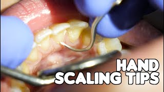 Dental Cleaning | Hand Scaling Tips