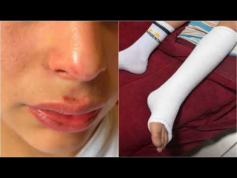 Denuncian que un policía golpeó a dos adolescentes en Alta Gracia: uno sufrió una fractura