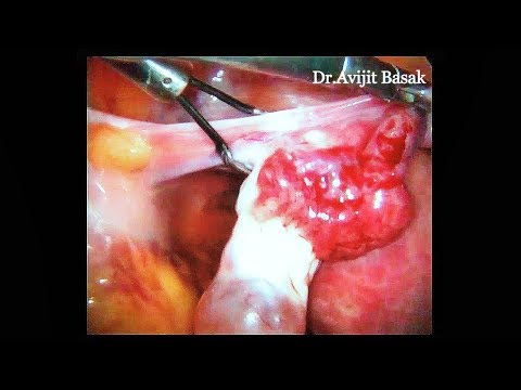 Total Laparoscopic Hysterectomy with Bilateral Salpingo Oophorectomy by Dr.Avijit Basak