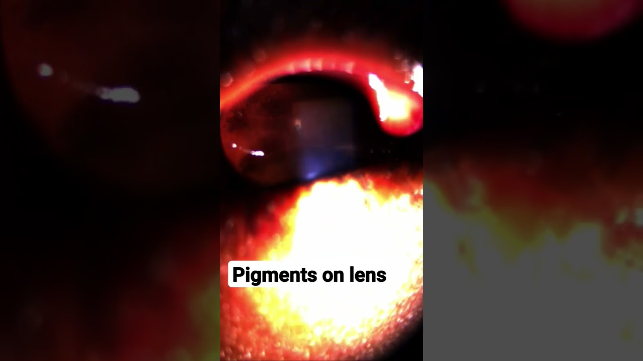pigments on lens