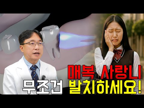 매복 사랑니 무조건 발치하세요!!