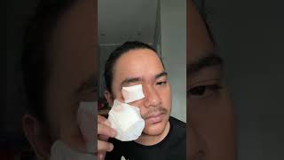 Download lagu Buka Perban Pasca Operasi Pengangkatan Kalazion / Bintitan Bertahun-Tahun mp3 Download lagu Buka Perban Pasca Operasi Pengangkatan Kalazion / Bintitan Bertahun-Tahun mp3