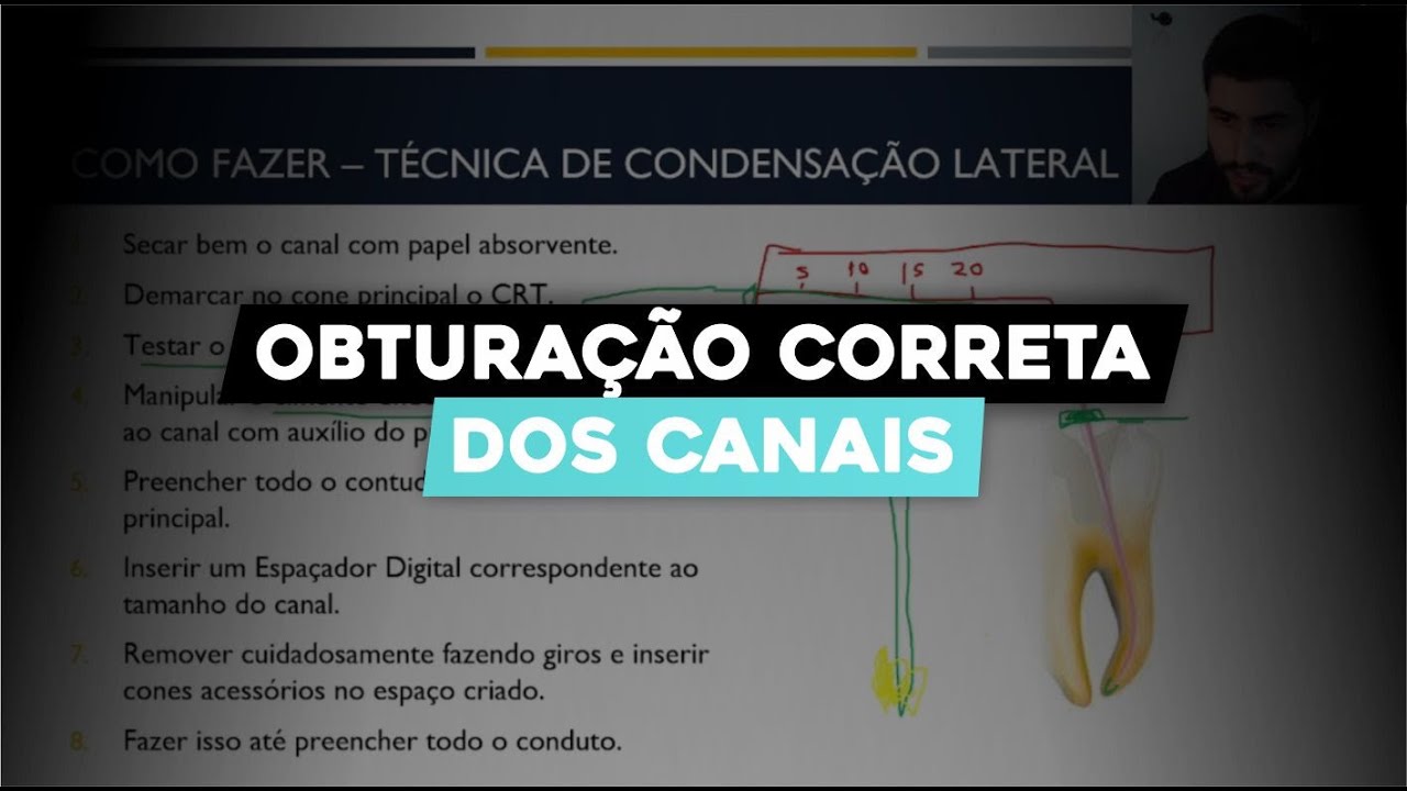 Como Fazer Obturação dos Canais Radiculares: Guia Completo de Endodontia