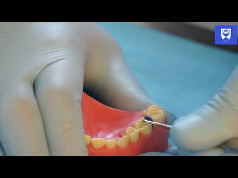 Usunięcie separatora ortodontycznego