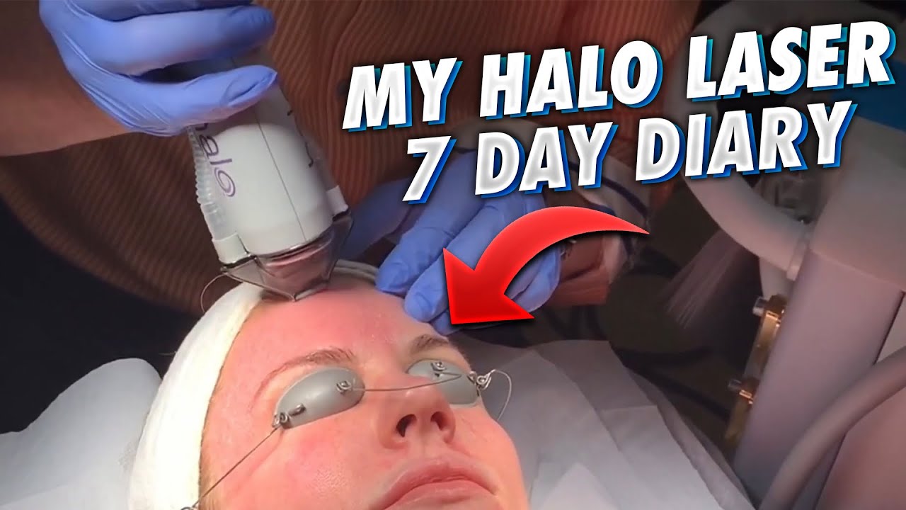 My Halo Procedure - Day by Day Recovery Diary \ Honest Review
