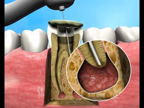 Treatment of Apical Periodontitis