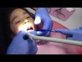 5 minutes Space-Maintainer By Dr. Idlibi, Kids Dental Care