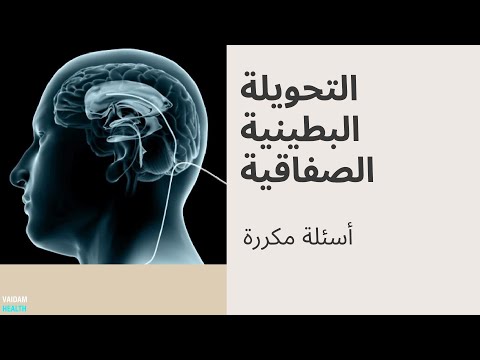 الأسئلة المتداولة حول التحويلة البطينية الصفاق
