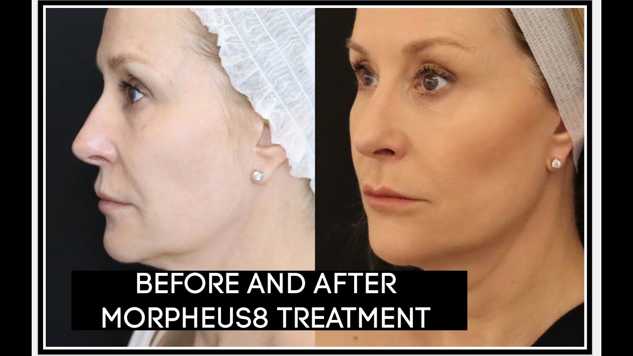 Watch video BEFORE AND AFTER MY MORPHEUS 8 TREATMENT Now BEFORE AND AFTER MY MORPHEUS 8 TREATMENT