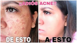 Remedio Casero para eliminar el acne 100% efectivo
