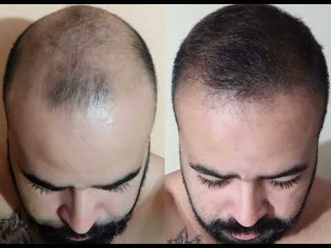 Antes e depois, Dutasterida e Minoxidil.