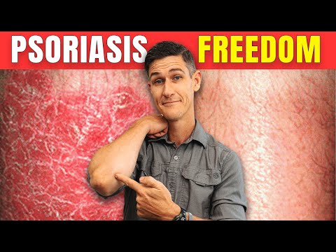 Psoriasis Uncovered: 3 Surprising Triggers You Need to Know