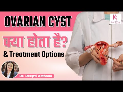 Ovarian Cyst क्या होता है? | Treatment Options for Ovarian Cyst in Hindi | Kalosa Gynae