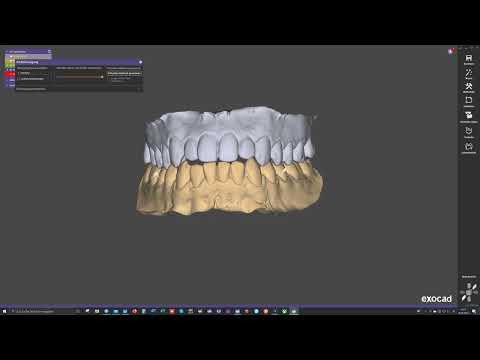 Reale Bewegungsdaten in Zebris aufgezeichnet und in Exocad importiert!