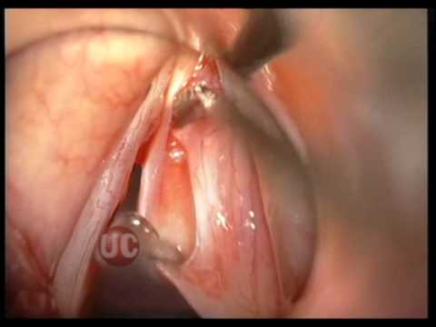 Quali test test passa a iperplasia prostatica Ghiandola prostatica parenchima