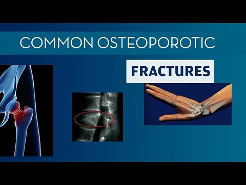 Térd osteoporosis kezelése 2 fokkal. Dr. Puskás Réka válasza a csontritkulás témában